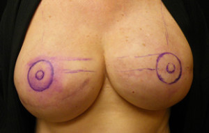 marking areolas